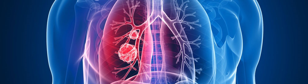 Kadınlarda akciğer kanserinin belirtileri - 1